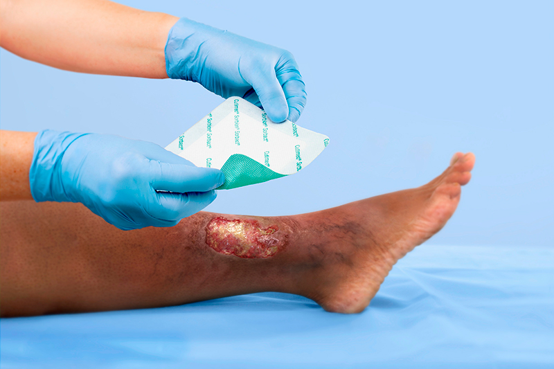 Infermiera che applica una medicazione Cutimed Sorbion Sorbact su una ferita alla gamba. Infermiera che applica una medicazione Cutimed Sorbion Sorbact su una ferita alla gamba.